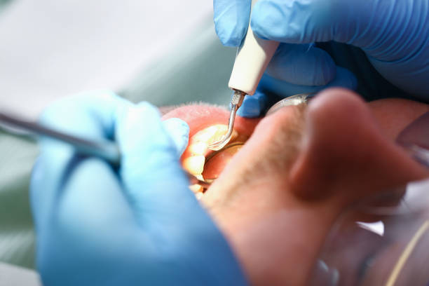 Best Emergency Dental Care for Broken or Chipped Teeth in Newark, TX