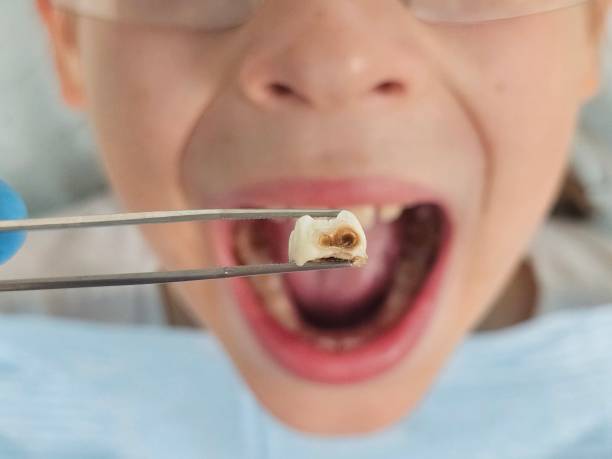 Best Emergency Treatment for Dental Infections or Abscesses in Newark, TX